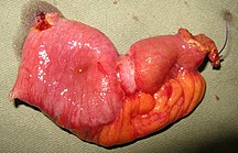 small bowel stricture caused by cancer shown in resected segment of intestine.