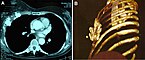 Strahlennekrose der linken Brust als Tomografie (links) und 3-D-Bild (rechts)