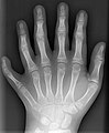 16. Polidaktiliában (sokujjúságban) szenvedő tízéves fiú kezének röntgenképe (javítás)/(csere)