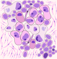 Rappresentazione D Carcinoma polmonare a grandi cellule: il quadro è dominato da pleomorfismo marcato, con elementi cellulari giganti frammisti a cellule immature, con nucleoli prominenti e formazioni nucleari aberranti.