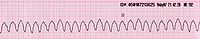 Tachicardia ventricolare: è un'aritmia ipercinetica caratterizzata da una frequenza ventricolare maggiore di 100 batt/min.[54] Le onde comuni dell'ECG non sono più riconoscibili, infatti l'origine degli impulsi elettrici è a livello ventricolare e ciò comporta uno slargamento dei complessi QRS, che appaiono regolari, generalmente caratterizzati da una sola morfologia (in tal caso si parla di battiti monomorfi).