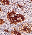 Emperipolesis in Rosai-Dorfman disease highlighted by S-100 staining.