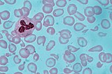 A Giemsa-stained blood film from a person with iron-deficiency anemia. This person also had hemoglobin Kenya.