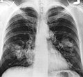 Radiografia del torace che mostra opacità compatibili con una neoplasia polmonare e metastasi linfonodali ilari e mediastiniche.