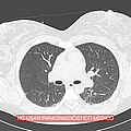 Imagen de corte de tomografía computarizada de pulmones con procesamiento para realce de bordes.