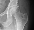 Radiografia dell'articolazione dell'anca