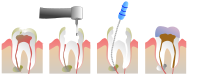 5: Endodontsko liječenje zuba