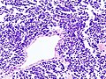 Immagine istologica E1 Carcinoma polmonare a piccole cellule: le cellule con nucleo intensamente cromofilo e scarso citoplasma si accrescono assumendo una struttura compatta e dall'aspetto organoide.