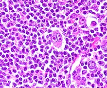 Hodgkin Disease, Reed-Sternberg Cell.jpg