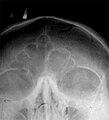 Radiografia che mostra i seni frontali