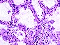 Immagine istologica C1 Carcinoma bronchioloalveolare: le cellule neoplastiche tappezzano i setti interalveolari rispettandone la struttura.