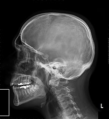 Radiografia di un cranio umano in laterale.