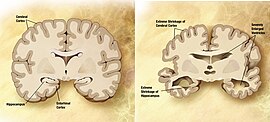 Зліва направо: головний мозок здорової людини у похилому віці та хворої особи з хворобою Альцгеймера