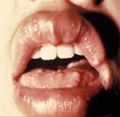 Нейрофиброма подслизистой оболочки губы 13-летнего пациента (синдром МЭН типа IIb)