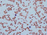 Red blood cells in sickle cell anaemia