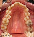 Fig.6. Déglutition salivaire infantile, atypique (adulte) et dysfonctionnelle. L'étalement horizontal de la langue ne stimule pas le développement du palais. Chez l'adulte, il en résulte un palais étroit et profond, associé à un encombrement dentaire (« contenu »).