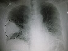 Tüdőgyulladásos (jobb középső lebenyi) terület röntgenképe