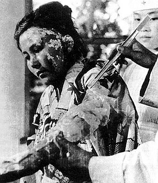 22-годишната жртва Тојоко Кугата која се лекувала во болницата на Црвениот крст во Хирошима (6 октомври 1945 година).