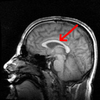 核磁気共鳴画像法で見たヒト頭部の矢状断。矢印の先、画像中央の白い所が脳梁。
