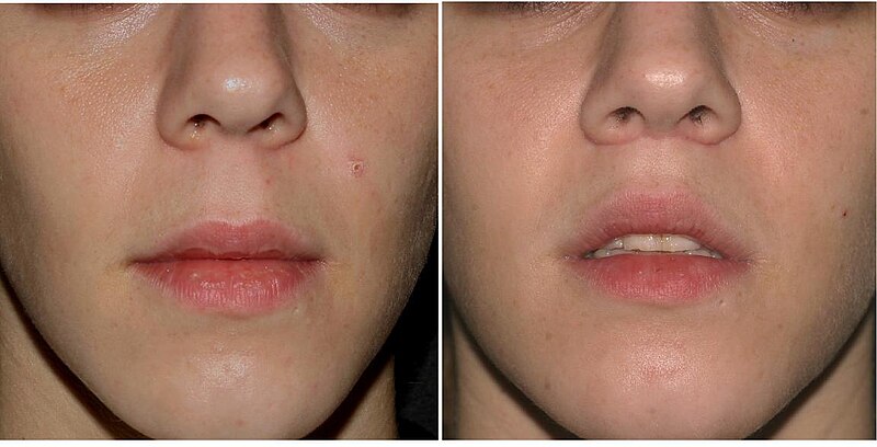 File:Lip Lift Before & After.JPG