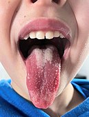 The tongue of a child showing the signs of scarlet fever caused by Lancefield group A streptococci