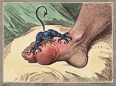 A small creature with sharp teeth is biting into a swollen foot at the base of the big toe