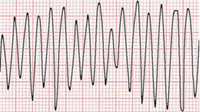 Flutter ventricolare: caratterizzato da onde ampie e sinusoidali con frequenze che oscillano fra i 150 e i 300 batt/min. Tale aritmia necessita di defibrillazione, poiché determina in tempi rapidi una sincope con collasso emodinamico.[55]