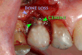Il cemento dentale sotto la gengiva causa peri-implantite e l'insuccesso dell'impianto.