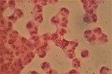 Gram stained pus from a urethral discharge with intracellular Neisseria gonorrhoeae