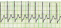 Tachicardia parossistica sopraventricolare: è un ritmo cardiaco ad alta frequenza, che origina al di sopra del ventricoli. Non sono visibili le onde P e la frequenza è in genere superiore ai 150 batt/min.