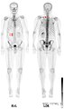 HDP-Skelettszintigramm eines Patienten mit Nierenkrebs: Die Knochenmetastasen im Halswirbelkörper 7 und in der Lendenwirbelsäule (LWK 1&2) sind aufgrund der geringen Auflösung der planaren Skelettszintigrafie nur zu erahnen.