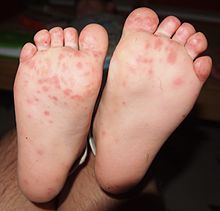 Rash on the soles of a child's feet