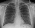 File:Chest_Xray_PA_3-8-2010.png by Stillwaterising (Public Domain)