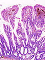 Adenoma serrato del colon (lesione benigna)