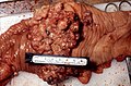 Adenocarcinoma vegetante del colon