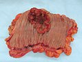 Carcinoma invasivo del colon. La formazione irregolare è caratterizzata da ulcerazione centrale