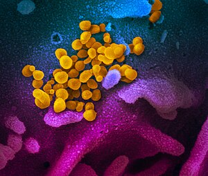 İnsan hücresinden çıkan SARS-CoV-2 (sarı)