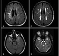 Personer med bipolär sjukdom har mellan 2,5 och 3 gånger högre benägenhet att uppvisa hyperintensitet vid undersökning med magnetisk resonanstomografi (MRI).