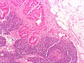 Metastasi linfonodale da adenocarcinoma del colon-retto