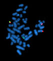 Hình 2: Ảnh chụp bộ nhiễm sắc thể người bệnh có Ph dưới kính hiển vi huỳnh quang.