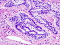 Carcinoide del colon, colorazione con ematossilina-eosina