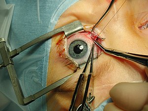Göz ameliyatı