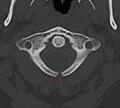 Rentgen kompyuter tomografiyasi C1 umurtqada bifida.