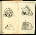De l'auscultation médiate ... Most of the plates in his book illustrate the diseased lung as do these four images that are consistent with lungs affected by tuberculosis.