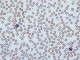 A Giemsa-stained blood film from a person with iron-deficiency anemia (lower magnification)