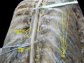 Médula espinal. Membranas y las raíces nerviosas espinales. Disección profunda. Vista posterior.