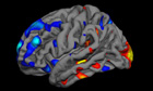 Autism brain scan