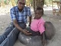 非洲男孩感染食肉菌双腿肿如象腿
