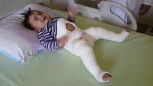 Operatör Doktor Gözen Çocuklarda görülen kalça çıkığı erken tedavi edilmeli