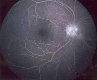 Retina Fluorangiografia